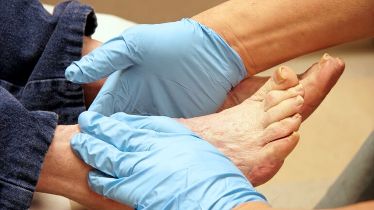 Behandlung des diabetischen Fußsyndroms