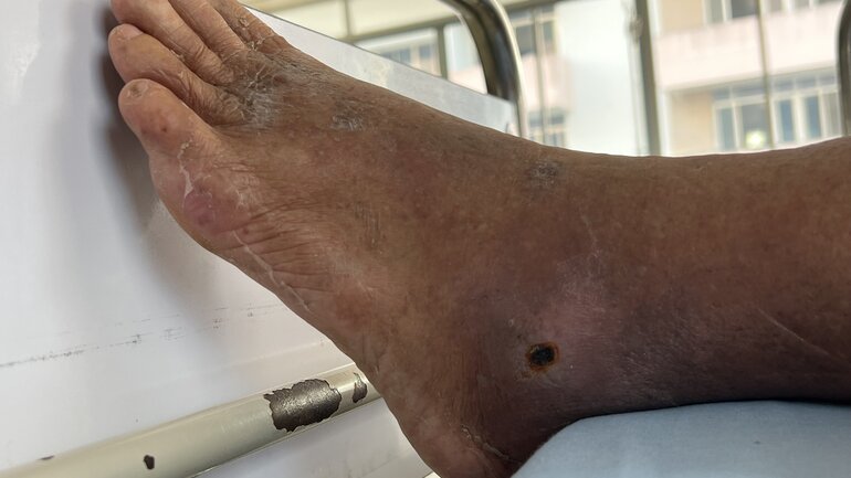 PAVK. Schlecht heilende Wunden an den Füßen sind Symptom