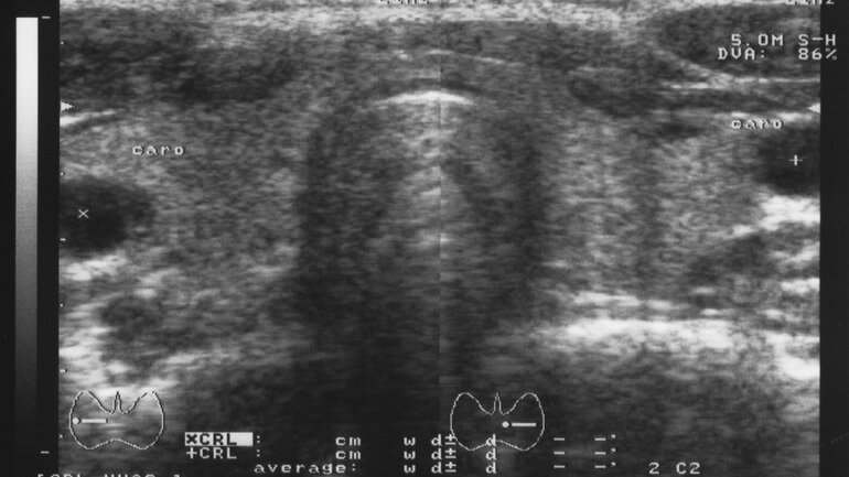 Ultraschall der Schilddrüse