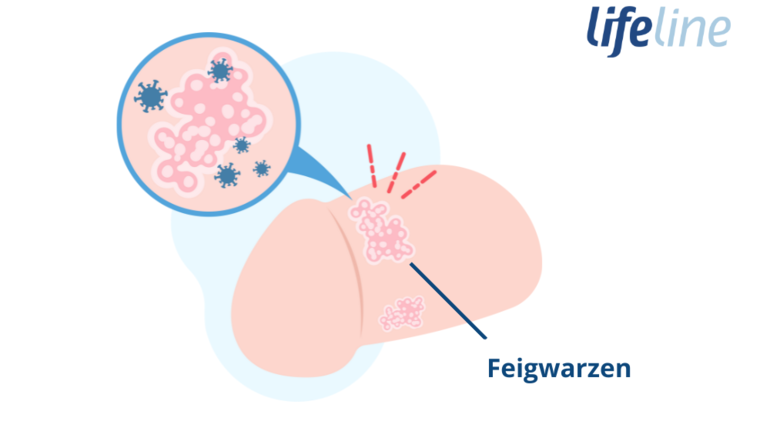 Bilder: Feigwarzen beim Mann