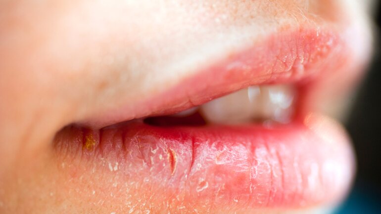 Flüssigkeitsmangel: Spröde Lippen sind Symptom
