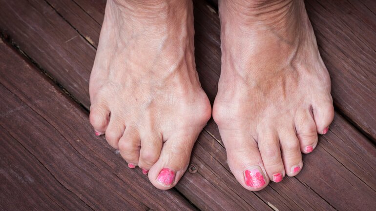 Hallux valgus verursacht Fußschmerzen