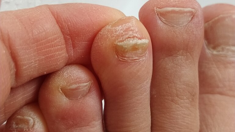 Fußpilz kann zu Nagelpilz führen