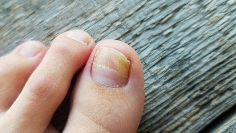 Nagelpilz erkennen und behandeln