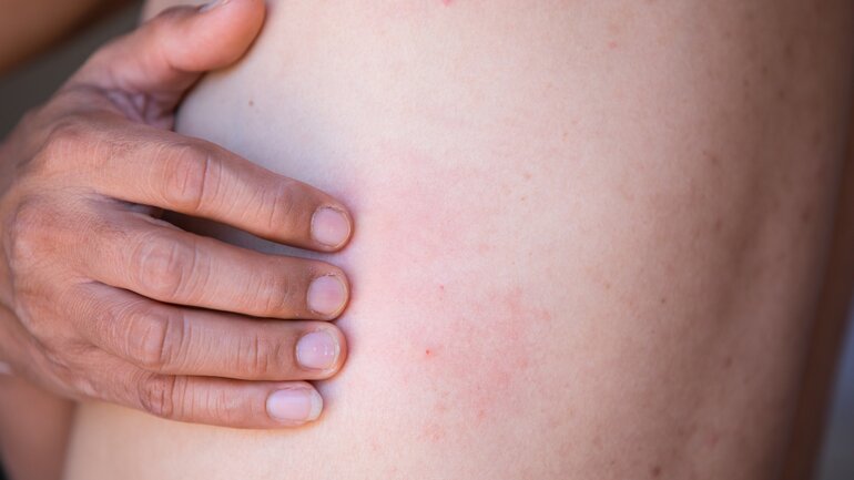 Erste Anzeichen von Herpes Zoster