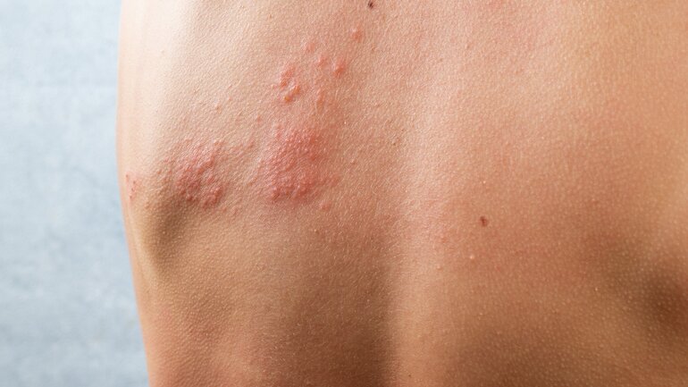 Typisches Gürtelrose-Symptom: Ausschlag
