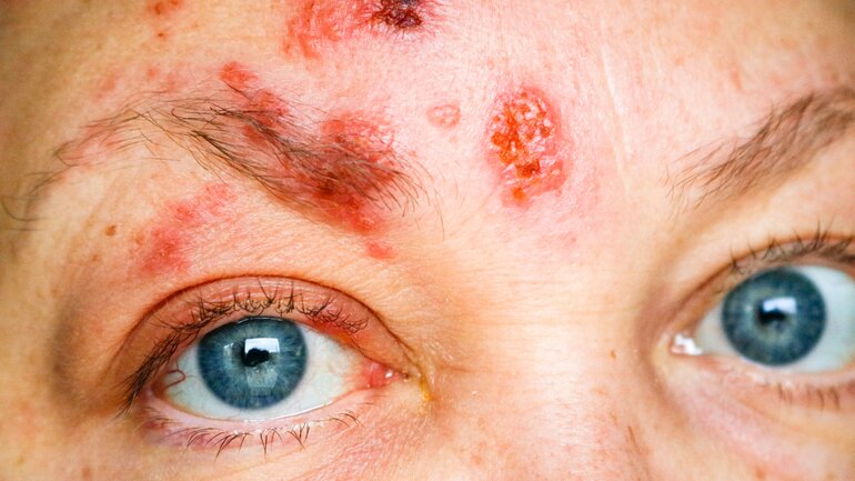 Gürtelrose im Gesicht: Symptome an Augen und Ohren