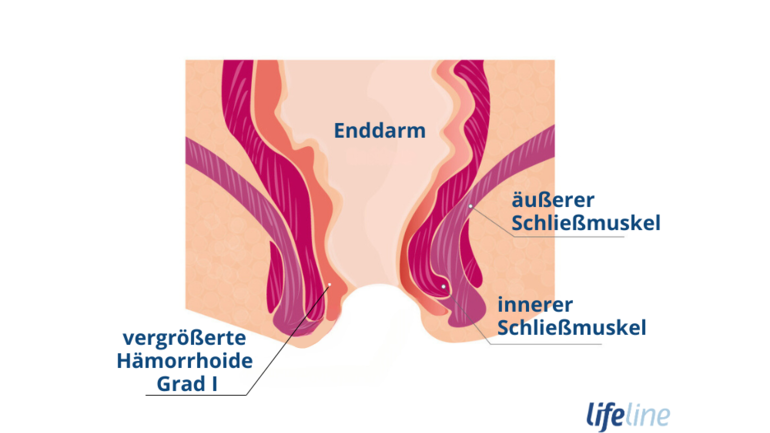 Bild von vergrößerter Hämorrhoide Grad 1