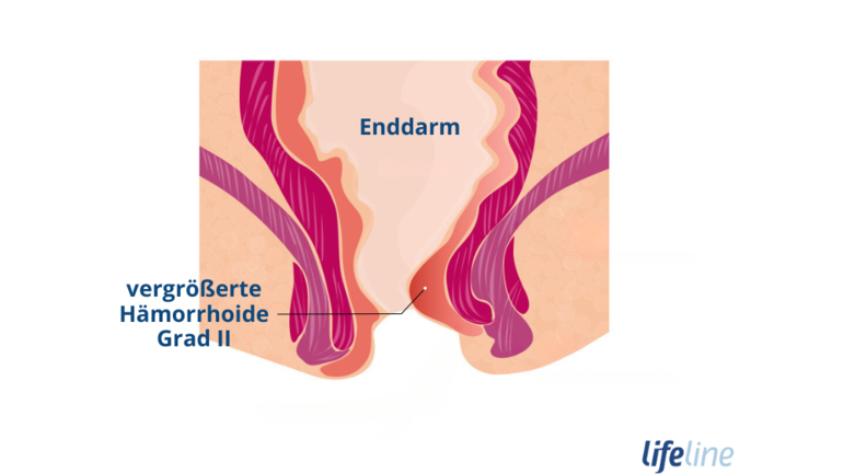 Aussehen von Hämorrhoiden Grad 2
