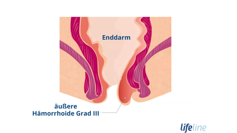 Wie sehen Hämorrhoiden Grad 3 aus?