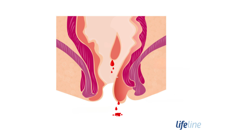 Wie sehen blutende Hämorrhoiden aus?