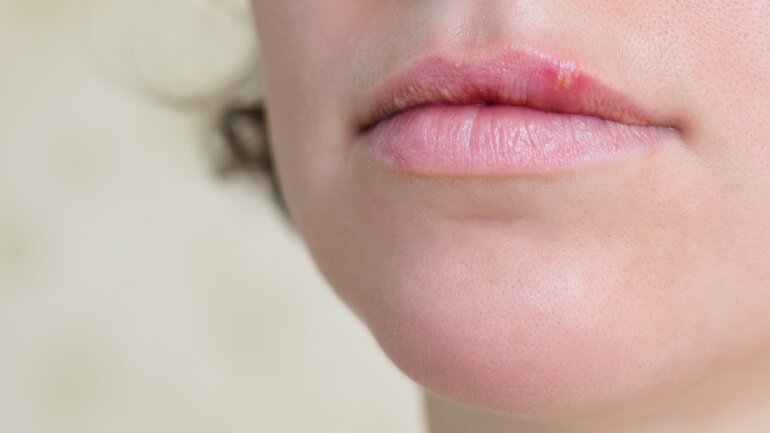Lippenherpes (Herpes simplex)