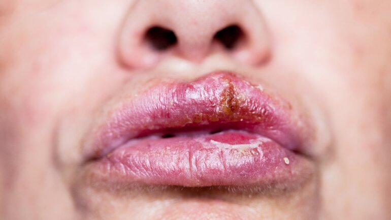 Lippenherpes infiziert