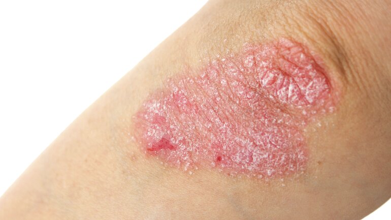 Schuppenflechte (Psoriasis)