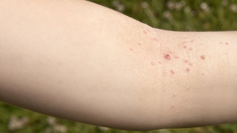 Ausschlag bei HPV (Humane Papilloma-Viren)