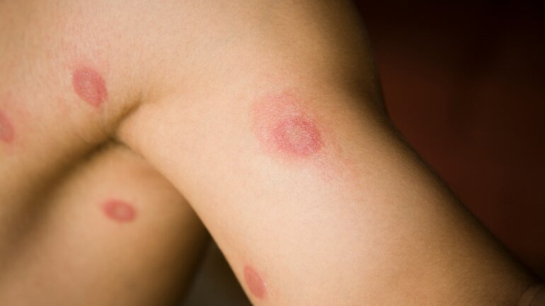 Hautausschlag durch Tinea corporis (Ringelflechte)