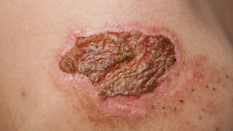 Ausschlag durch Impetigo