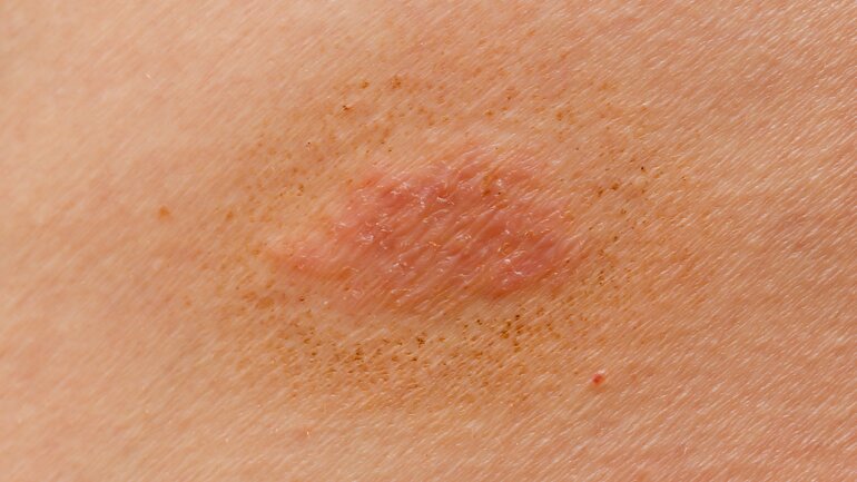 Ringelflechte (Tinea corporis)