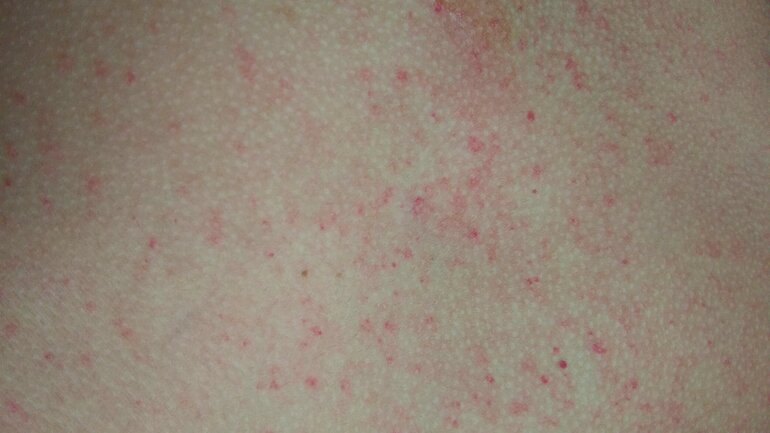 Einblutungen durch Thrombozytopenie