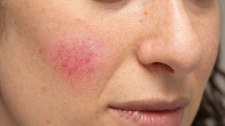 Couperose und Rosacea