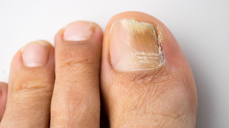 Nagelpilz