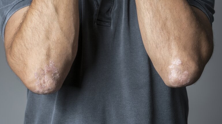 Psoriasis am Ellenbogen
