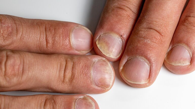 Nagelpsoriasis