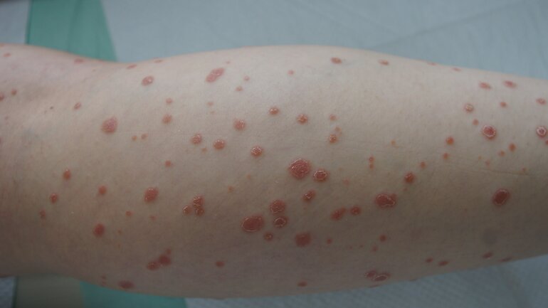 Psoriasis guttata
