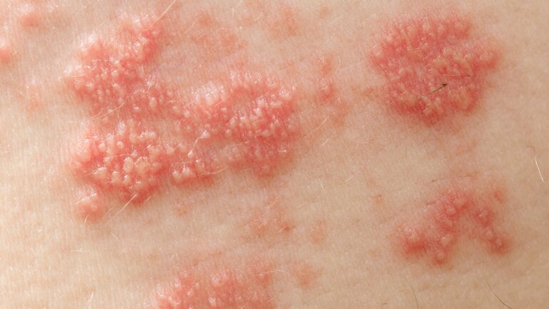 Gürtelrose (Herpes zoster)