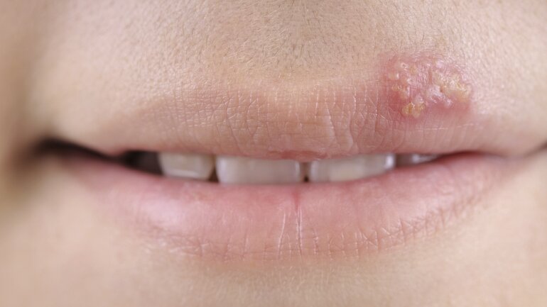 Lippenherpes