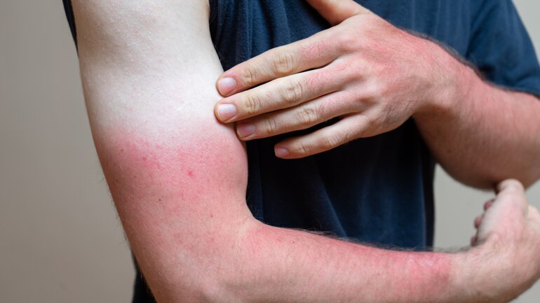 Sonnenbrand