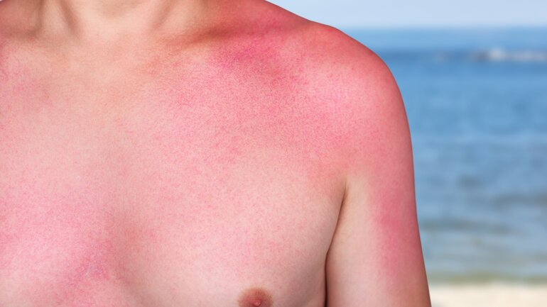 Sonnenallergie