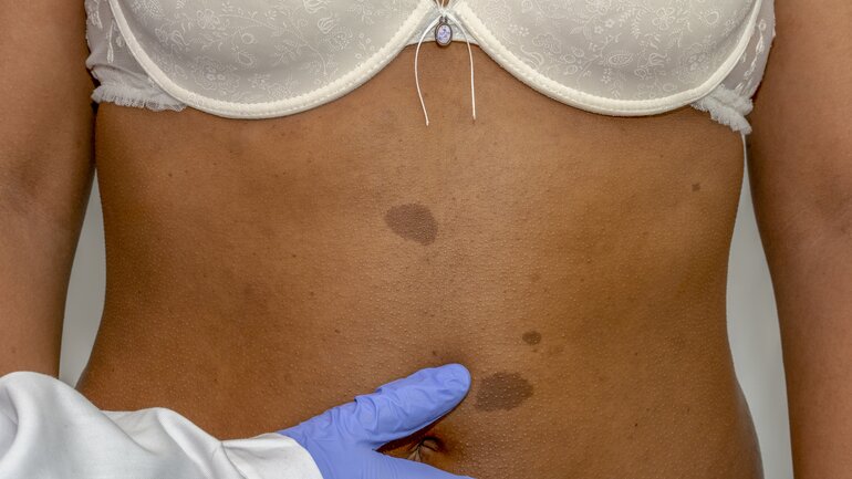 Neurofibromatose