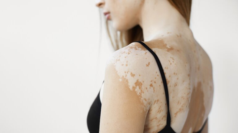 Hautkrankheit Vitiligo
