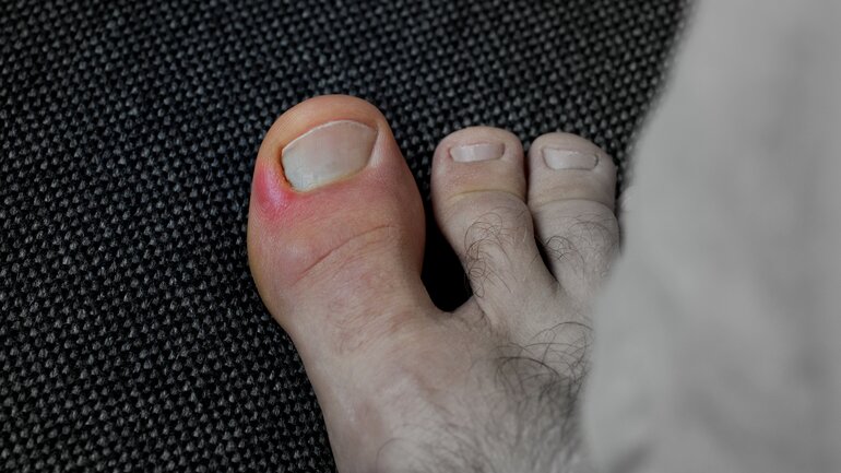 Hautkrankheit Nagelbettentzündung