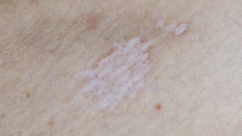Lichen sclerosus