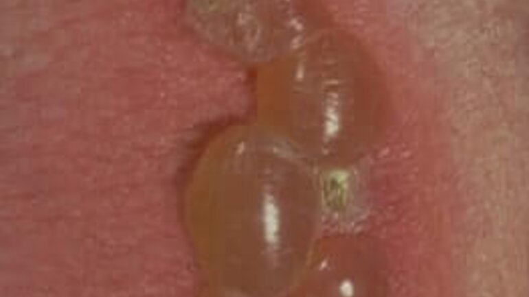 Bild von Hautkrankheit Bullöses Pemphigoid