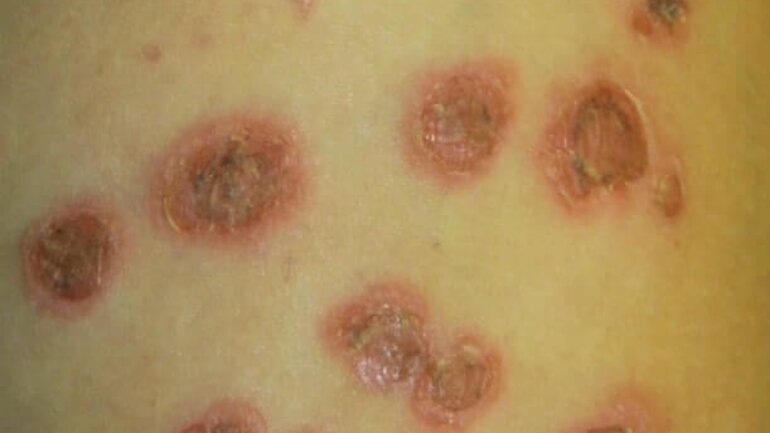 Bild von eitrigen Krusten (ebenfalls bei Impetigo contagiosa)