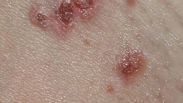 Bläschenbildung bei Hautkrankheit Impetigo contagiosa