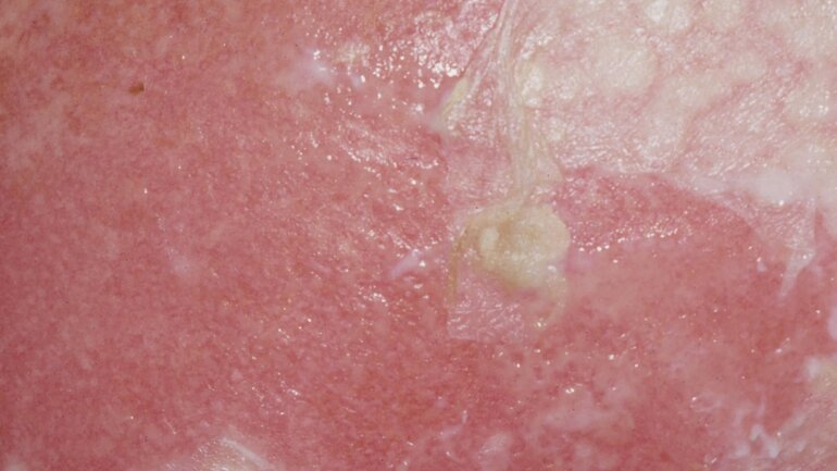 Oberflächliche Hautveränderung namens Staphylococcal Scalded Skin Syndrom (SSSS)
