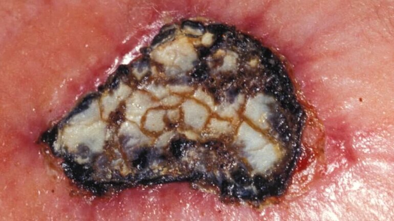 Hautkrankheit: Ulcus mit Nekrose
