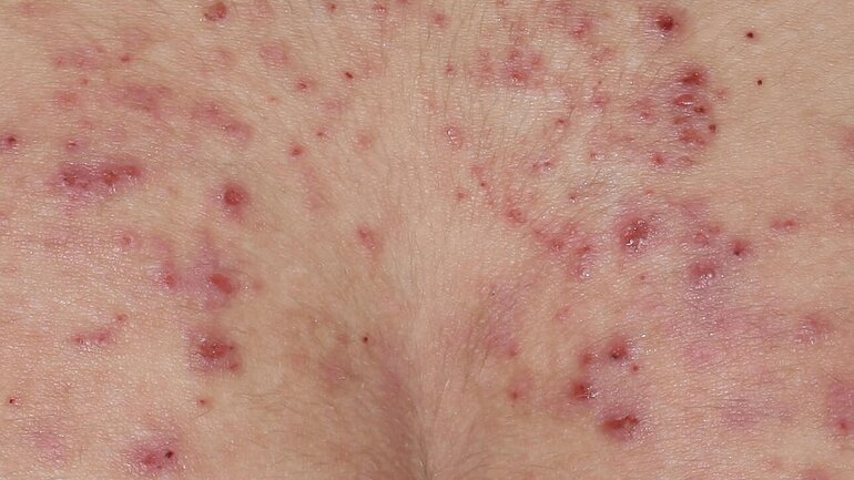 Atopisches Ekzem im Bereich des unteren Rückens und Gesäßes