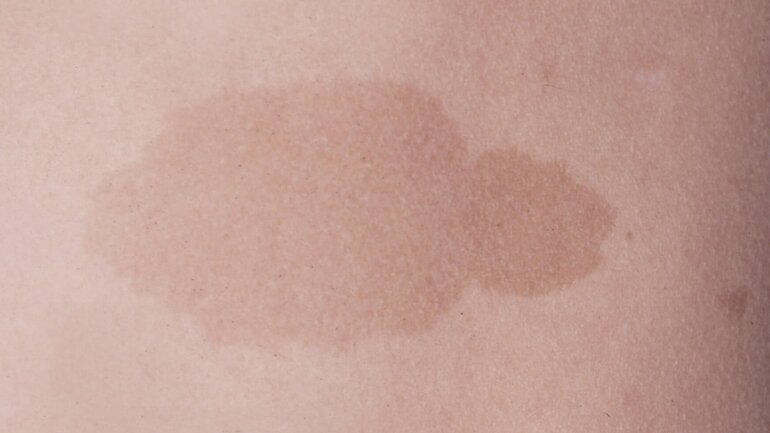Bild von Café-au-lait-Fleck