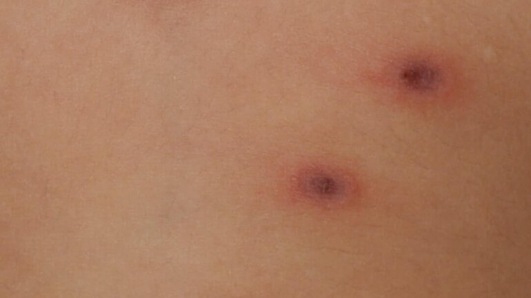 Nekrose: Hautkrankheit bei Pityriasis lichenoides acuta