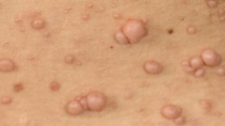 Bild von Neurofibromen