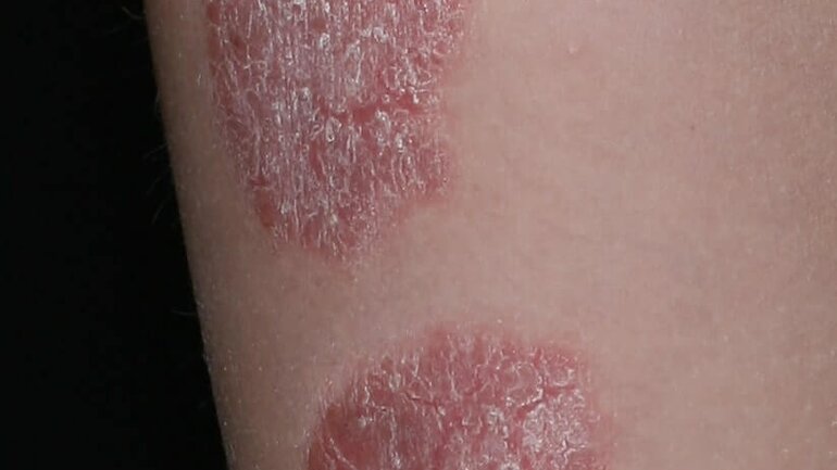 Bild von Schuppenflechte (Psoriasis vulgaris)