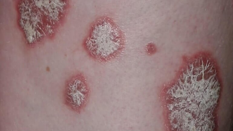 Schuppenflechte (Psoriasis vulgaris) II