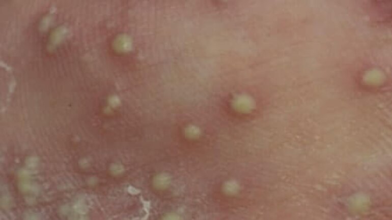 Aussehen von Schuppenflechte mit Bläschen (Psoriasis pustulosa)