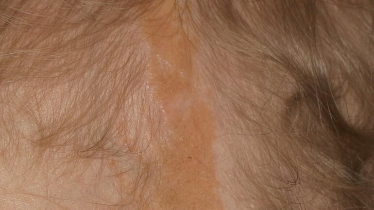 Gutartiger Hauttumor (Naevus sebaceus)