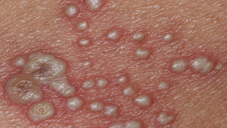 Hautkrankheit: Bläschen bei Gürtelrose (Herpes zoster) I